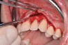 Fig 10. Initial incisions, and blunt, split-thickness dissection for tension-free closure.