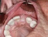 Fig 7. Healing at 10 days, occlusal view.