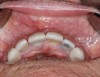 Fig 8. Restoration at 14 months, occlusal view (Fig 8) and buccal view (Fig 9).
