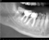 Fig 12. Preoperative CBCT-reconstructed radiograph.