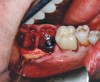 Fig 14. Extraction site, with mesiobuccal bone dehiscence concealed under soft tissue, and immediate implant placement with ISQ post in position.