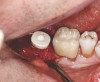 Fig 15. Grafting with particulate mineralized cortico-cancellous allograft and placement of PEEK healing abutment.