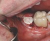 Fig 17. A layer of dHACM was placed to seal the healing abutment–soft-tissue gap, saturated with saline, and secured with 4-0 chromic gut.