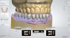 Fig 5. The digital impression was exported from the intraoral scanner and imported into a dental laboratory software package, and using a wizard step-by-step function, the prosthesis scan was converted into a digital denture with two files: one for the teeth arch and the second for the denture base.
