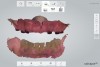 Fig 13. Denture attachment housings were placed onto each abutment and a digital impression was made using an intraoral scanner. A digital impression of the patient’s opposing teeth and occlusion was also captured, using the patient’s existing interim denture and anatomical features of the edentulous ridge as a marker for the scanner.