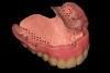 Fig 17. The milled polymer framework was luted to the milled PMMA denture base using micromechanical abrasion and composite resin. Denture teeth were luted to the milled PMMA denture base using autopolymerizing acrylic resin.