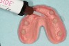 Fig 18. The patient returned for placement of the prosthesis. Complete adaptation of the prothesis was confirmed, block-out spacers and denture attachment housings were placed onto each abutment, and composite resin material was placed into each recess. The denture was placed onto the edentulous ridge, confirming complete adaptation over the housings.