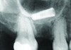 An implant that migrated into the sinus may be considered a major reversible complication.