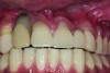 Maxillary right lateral incisor implant restoration with severe bone and soft tissue loss is classified a major complication which may not be completely reversible.