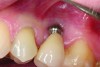 A implant restoration with a buccal dehiscence of bone and soft tissue caused by poor implant positioning, lack of keratinized tissue prior to implant placement, and soft tissue recession post implant restoration.