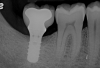 At 1 year following treatment, probing depths are now 3 mm with an absence of bleeding.