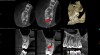 Fig 3. Case 1: CBCT showed a large lateral canal within the palatal root (Fig 3). There was a small preparation space, which was efficiently obturated (Fig 4). A small pinpoint of sealer in the middle of the palatal root indicated that the palatal lateral canal had been addressed (Fig 5). After 5 months, CBCT demonstrated complete healing (Fig 6), notably on the distal, where probing had resolved to 2 mm. Radiographic images were taken immediately postoperatively (Fig 7) and 5 months postoperatively (Fig 8).