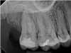 Fig 4. Case 1: CBCT showed a large lateral canal within the palatal root (Fig 3). There was a small preparation space, which was efficiently obturated (Fig 4). A small pinpoint of sealer in the middle of the palatal root indicated that the palatal lateral canal had been addressed (Fig 5). After 5 months, CBCT demonstrated complete healing (Fig 6), notably on the distal, where probing had resolved to 2 mm. Radiographic images were taken immediately postoperatively (Fig 7) and 5 months postoperatively (Fig 8).