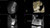 Fig 6. Case 1: CBCT showed a large lateral canal within the palatal root (Fig 3). There was a small preparation space, which was efficiently obturated (Fig 4). A small pinpoint of sealer in the middle of the palatal root indicated that the palatal lateral canal had been addressed (Fig 5). After 5 months, CBCT demonstrated complete healing (Fig 6), notably on the distal, where probing had resolved to 2 mm. Radiographic images were taken immediately postoperatively (Fig 7) and 5 months postoperatively (Fig 8).