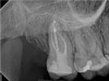 Fig 7. Case 1: CBCT showed a large lateral canal within the palatal root (Fig 3). There was a small preparation space, which was efficiently obturated (Fig 4). A small pinpoint of sealer in the middle of the palatal root indicated that the palatal lateral canal had been addressed (Fig 5). After 5 months, CBCT demonstrated complete healing (Fig 6), notably on the distal, where probing had resolved to 2 mm. Radiographic images were taken immediately postoperatively (Fig 7) and 5 months postoperatively (Fig 8).