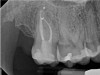 Fig 8. Case 1: CBCT showed a large lateral canal within the palatal root (Fig 3). There was a small preparation space, which was efficiently obturated (Fig 4). A small pinpoint of sealer in the middle of the palatal root indicated that the palatal lateral canal had been addressed (Fig 5). After 5 months, CBCT demonstrated complete healing (Fig 6), notably on the distal, where probing had resolved to 2 mm. Radiographic images were taken immediately postoperatively (Fig 7) and 5 months postoperatively (Fig 8).