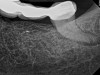 Fig 9. Case 2: Significant bone loss on the mesial and apical aspect suggested a potential vertical fracture (Fig 9 and Fig 10). Radiographic images were taken immediately postoperatively (Fig 11) and 7 months postoperatively (Fig 12).