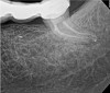 Fig 12. Case 2: Significant bone loss on the mesial and apical aspect suggested a potential vertical fracture (Fig 9 and Fig 10). Radiographic images were taken immediately postoperatively (Fig 11) and 7 months postoperatively (Fig 12).