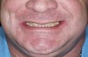 Fig 1. Preoperative extraoral view of a patient’s smile exhibiting compromised esthetic situation.