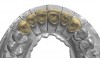 Fig 6. Full-contour CAD/CAM design of maxillary anterior teeth.