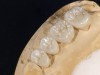 Fig 11. Lingual view of maxillary left posterior high-translucent zirconia restorations on the model.