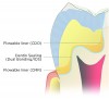 Fig 3. Diagrammatic illustration of a modern concept for “Indirect Adhesive Restorations in the Posterior,” presented by Dr. Didier Dietschi. The different layers indicate the concepts of dual bonding/immediate dentin sealing (IDS), cavity design optimization (CDO), and cervical margin relocation (CMR).