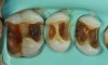 Fig 5. Situation after removal of the failing restorations. Recurrent caries involved proximal areas, leading to extensive proximal cavities. The remaining enamel is very thin or even absent along the cervical margins. A direct approach is not indicated due to cavity dimensions, margin position, and dentin quality.