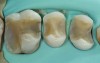Fig 7. All cavities were lined (dentin bonding agent and flowable composite). Enamel margins were refinished, and cavities are ready for final impression.