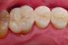 Fig 10. Definitive restorations. The restorative approach ensures optimal biologic and physical integration for predictable and reliable results. Clinics by Dr. Didier Dietschi.