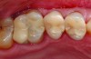 Fig 4. Preoperative view of defective tooth-colored restorations. Improper adaptation and open margins necessitate replacement.