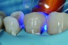 Cementation with a light-cure composite material (typically a microhybrid).