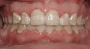 Figure 6 Post-orthodontic white-spot lesions in a patient with poor oral hygiene.