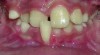 Figure 1 A 9-year-old patient with an untreated anterior crossbite exhibiting severe and irreversible gingival recession.
