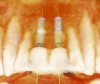 Fig 1. Pretreatment plan for guided implant surgery to replace teeth Nos. 8 and 9.