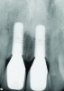 Fig 6. Radiograph of crown Nos. 8 and 9, 2 years after implant placement.