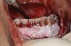 Fig 2. An abundant amount of bone biomaterial was placed during SFOT to compensate for anticipated graft shrinkage during healing.