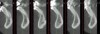 Fig 6. CBCT post-SFOT; note the compromised osseous regenerative outcome, which possibly was associated with the baseline etiology of the prominent symphysis and muscle pull that was not addressed.