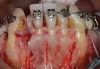 Fig 9. SFOT intraoperative surgical photograph; note the correlation of the CBCT scan in Fig 7 with the surgical findings, confirming the lack of blood supply even after completion of corticotomies.