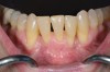 Fig 13. Final outcome after SFOT; note proper alignment of teeth yet limited attached gingiva with compromised root coverage and shallow vestibule still present post-surgery.