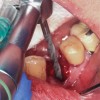 Fig 4. Osteotomy into the extraction socket under robotic guidance.