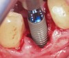 Fig 7. Implant placement into the extraction socket under robotic guidance.