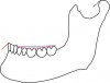 Fig 1. Hanau quint is used to describe the balancing of occlusion: condylar guidance (black dotted line), incisal guidance (red solid line), orientation of occlusal plane (blue solid line), compensating curve (red dotted line), and cuspal incline.