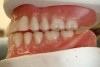 Fig 9. Balanced articulation in lateral excursion of the mandible: left balancing side.