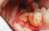 Fig 1. Impacted mandibular third molar showing mesial angular orientation after flap elevation to expose the tooth in preparation for extraction.