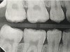 Fig 5. Three thin soft dental picks were used simultaneously for SDF proximal surface saturations in a teenaged patient (Fig 3). After 60 seconds, the treated regions were covered with 5% fluoride varnish (Fig 4). A comparison can be seen of pre-SDF-treatment bitewing films (Fig 5) and 8-month post-SDF bitewing films (Fig 6) for the patient shown in Fig 3 and Fig 4. Radiolucencies were similar or improved, except for contact of maxillary first and second molars.