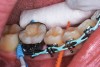 Fig 10. Interproximal sites in orthodontic patients can also benefit from preventive or interceptive SDF applications.