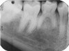 Fig 18. A 15-year-old girl with retained mandibular primary second molar and congenital absence of second premolar (Fig 16). In bitewing film small radiolucencies revealed beginning caries lesions at contact points of primary second molar and adjacent first molar (Fig 17); 12 months later, after initial SDF and 6-month follow-up SDF applications (Fig 18), radiolucencies were not evident.