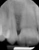 Fig 17 and Fig 18. Post-treatment radiographs.