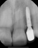 Fig 17 and Fig 18. Post-treatment radiographs.