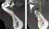 Fig 2. (Left) An example of a mandibular anterior tooth, No. 27, that was treated with extraction and replacement with a single implant. Note the concavity in the alveolus apical to the tooth. There was inadequate apical bone for extraction and immediate implant placement, thus a 2-stage surgical approach was planned. In this case, had only the socket been filled with grafting material there still would not have been enough bone present for proper implant placement. A full-thickness flap was created and GBR performed to both preserve the site and correct the apical deficiency for implant placement. (Right) Note the new bone formed buccal to the ridge and the bone now available for implant placement.